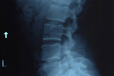 Spinal Cord Injury