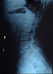 spinal cord injuries